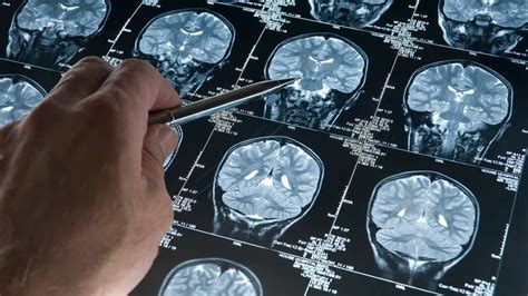 Alzheimer La Fda Aprobó Un Fármaco Que Demostró Ralentizar El Deterioro Cognitivo En La Primera