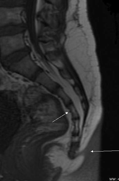 Coccygeal Lipoma Mri Sumer S Radiology Blog