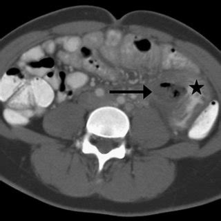 A Ct Scan Of The Abdomen And Pelvis Demonstrated A Thickened Loop Of