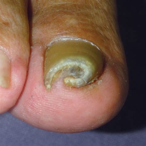 A Novel Nonsurgical Treatment For Pincer Nail That Involves Mechanical