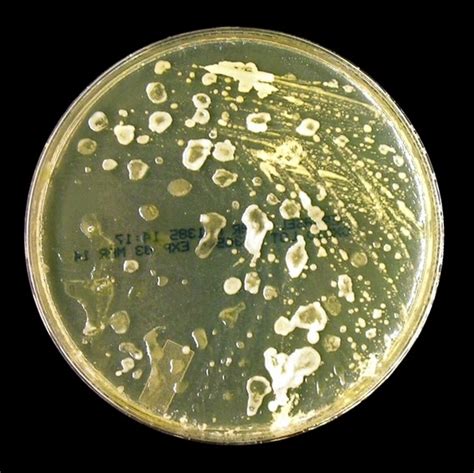 Tinea Versicolor Caused By Malassezia Furfur Infection And Laboratory