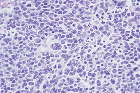 Rhabdomyosarcoma - Pathology - Orthobullets