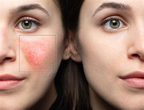 Ipl For Rosacea Benefits Side Effects And More