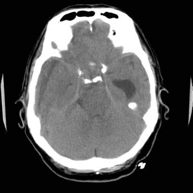 Brain Herniation Imaging: Overview, Computed Tomography, Magnetic ...