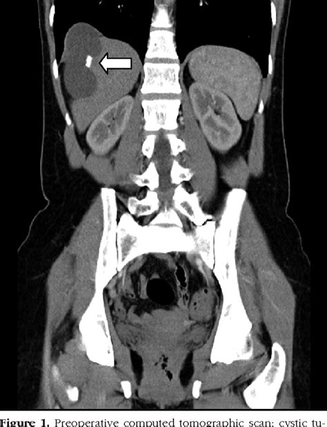 Figure 1 From Laparoscopic Resection Of An Intradiaphragmatic