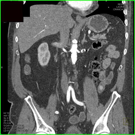 Metastatic Renal Cell Carcinoma To The Pancreas And Perirenal Space