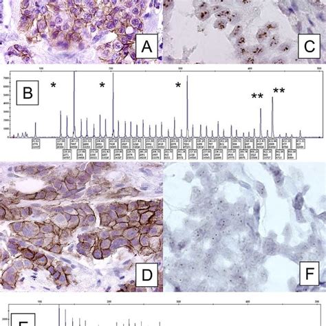 Comparison of the HER-2/neu protein overexpression by... | Download ...