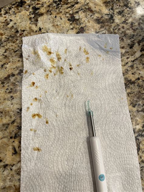 Dry Ear Wax