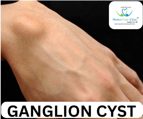 Ganglion Cyst Causes Symptoms And Homeopathy Treatment