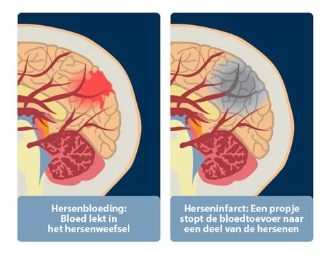 Axon Niet Aangeboren Hersenletsel Geoffrey Cramm