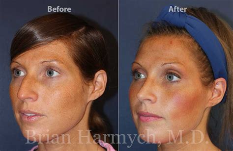 Rhinoplasty In Cleveland Ohio Cleveland Facial Plastic Surgeon