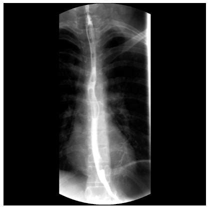 Blunt Trauma Patient With Esophageal Perforation The Western Journal