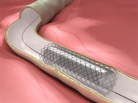 Cateterismo Card Aco E Angioplastia Stent Michel Kalansky