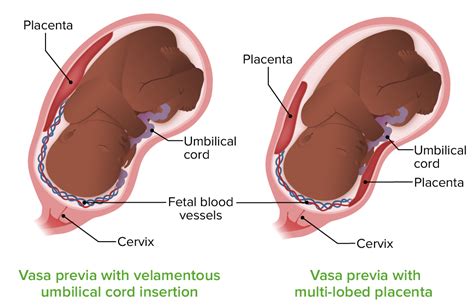 Vasa Previa Causes Symptoms Management Treatment Explore O