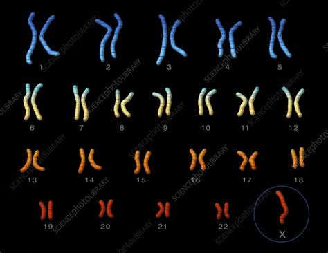 Turner's syndrome karyotype, illustration - Stock Image - C055/5471 - Science Photo Library