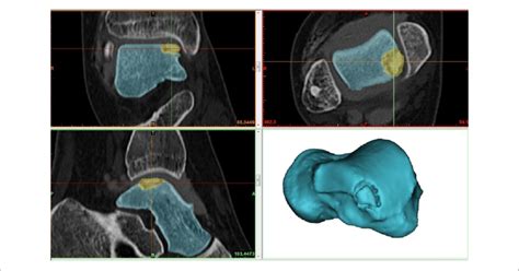 Illustration Of 3d Reconstruction Taken From Computed Tomography Views Download Scientific