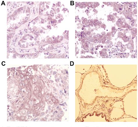 Figure From Role Of Axl Expression In Non Small Cell Lung Cancer