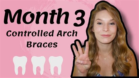 Month 3 Controlled Arch Braces Youtube