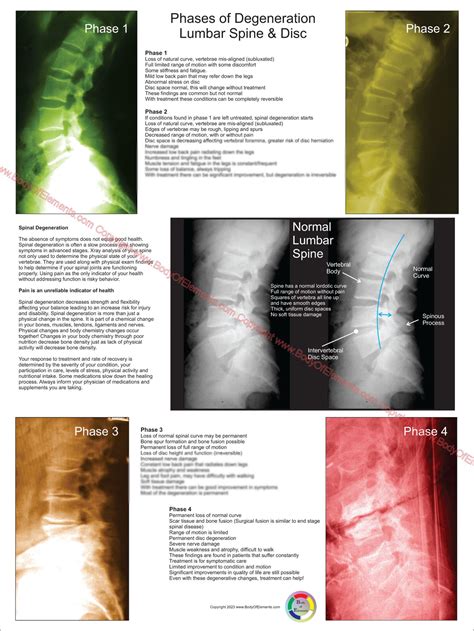 Lumbar Spinal Degeneration Phases Poster – Body of Elements