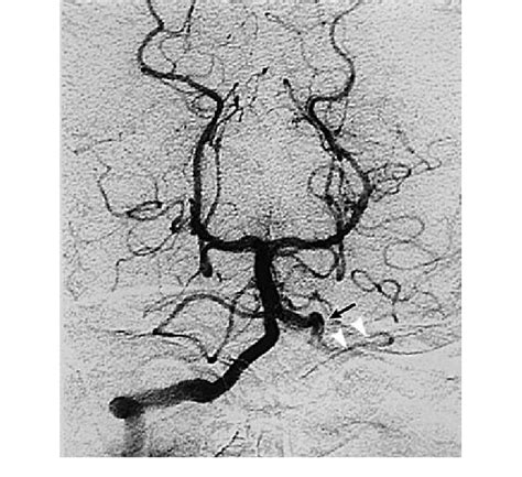 Right Vertebral Angiogram Anteroposterior View On The Day Of