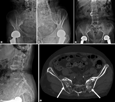 Normal Sacroiliac Joint X Ray