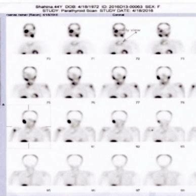 Early phase of parathyroid scan | Download Scientific Diagram