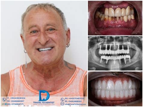 Sonríe con confianza Puente dental transformación antes y después