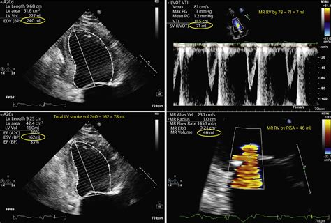 Basic Principles Of The Echocardiographic Evaluation Of Mitral