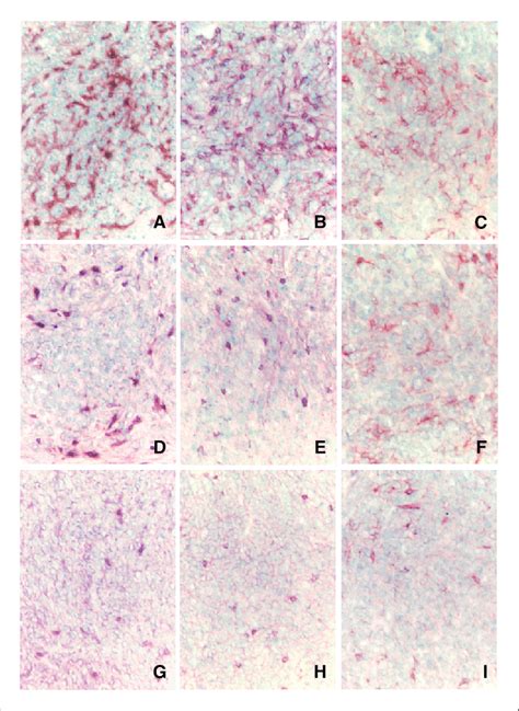 Immunohistochemical Staining For Tumor Infiltrating Cd4 A D And