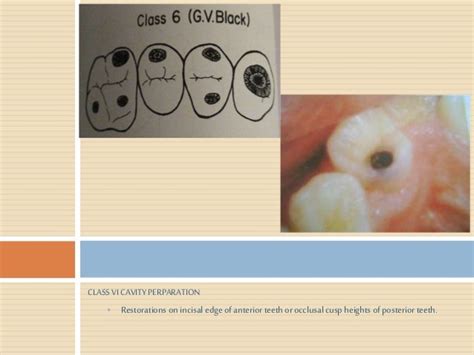 Dental Caries Ppt