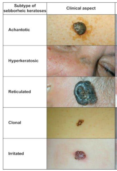 Laser Age Warts Removal - Dr Peter Kim Surgery - Skin Cancer, Cosmetic ...