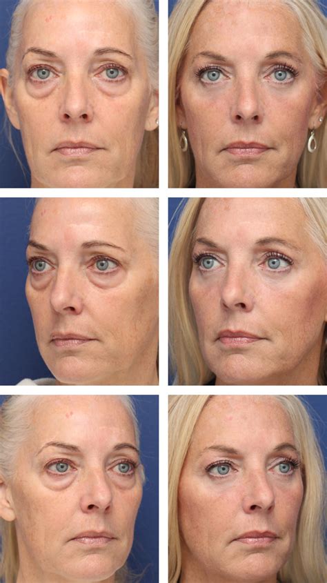 Blepharoplasty Upper Eyelid Before And After