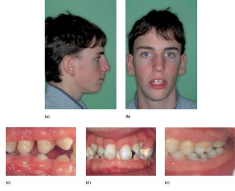 Figure From Idiopathic Gingival Hyperplasia And Orthodontic Treatment