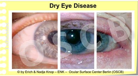 Overview What Is Dry Eye — Ocular Surface Center Berlin