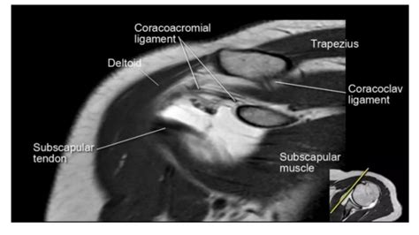 How To Read Shoulder Mri Ppt