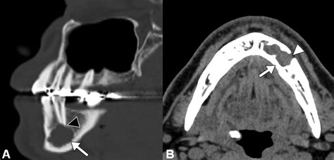 Cystic And Cystic Appearing Lesions Of The Mandible Review Ajr