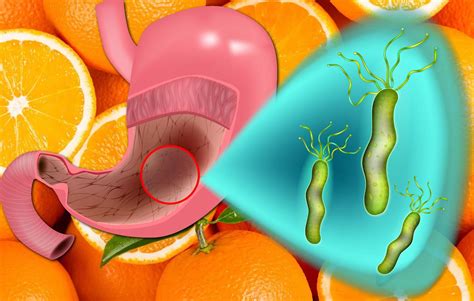 Vitamine C E D Contro Helicobacter Pylori Dosi Benefici Consigli