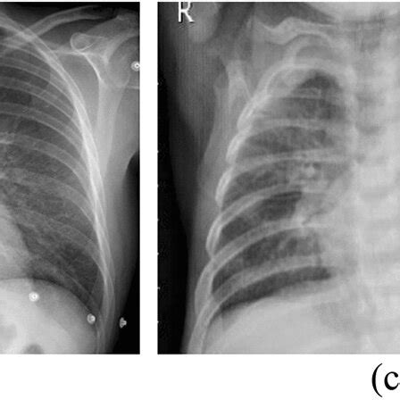 Samples of normal a, COVID-19 b, Bacterial Pneumonia c and Viral ...