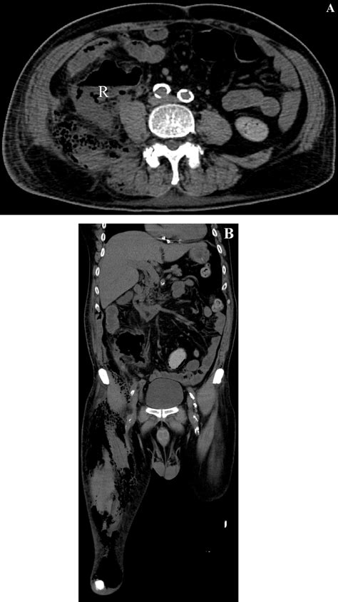 A 73 Year Old Male Patient With Non Contrast Enhanced Ct A Axial Download Scientific Diagram