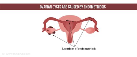 Ovarian Cysts Types Causes Symptoms Diagnosis Treatment