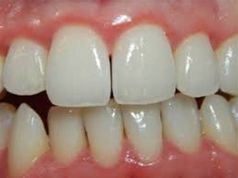 Gingivitis Ulcerativa Necrosante Causas S Ntomas Tratamiento