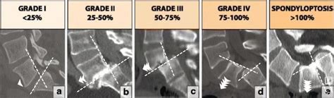 6 Easy Lumbar Spondylolisthesis Exercises to Correct Anterolisthesis and Related Low Back Pain