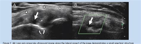 Figure From Symptomatic Ganglion Cyst Of The Popliteus Tendon Treated