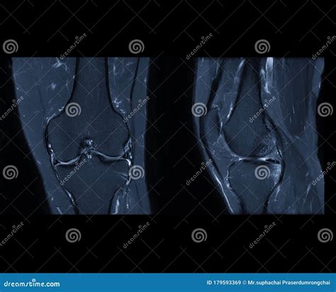 Compare Of Mri Knee Or Magnetic Resonance Imaging Of Knee Joint Stir