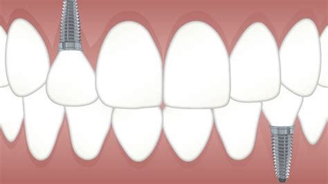 Surprising Facts About Dental Implants Guidebytips