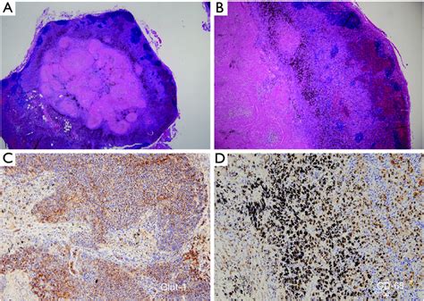 Histological Findings Of Resected Lymph Nodes With PET False Positive