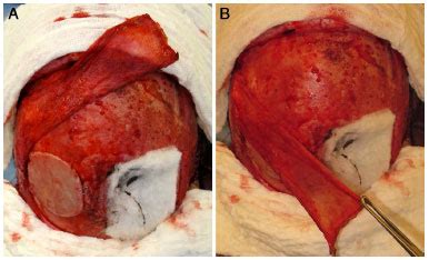 RBCP Cranioplastias estratégias cirúrgicas de reconstrução