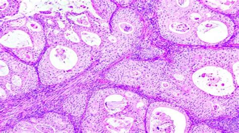 Micrograph Showing Multiple Transitional Epithelial Cell Nests H And