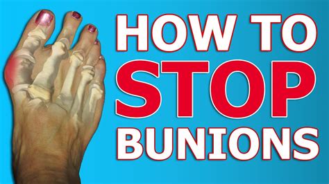 3 Tips To Correct Bunions Physical Therapy Exercises And Taping