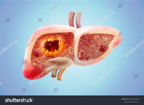 Liver Cancer Liver Tumor Hepatocellular Carcinoma Stock Illustration ...